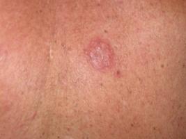 Basal cell & or Squamus cell carcinoma natural treatment